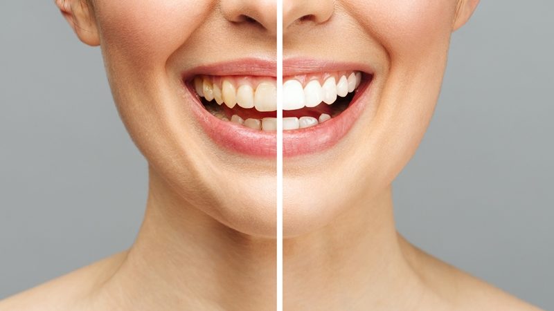 Clareamento Dental - Dente Sim