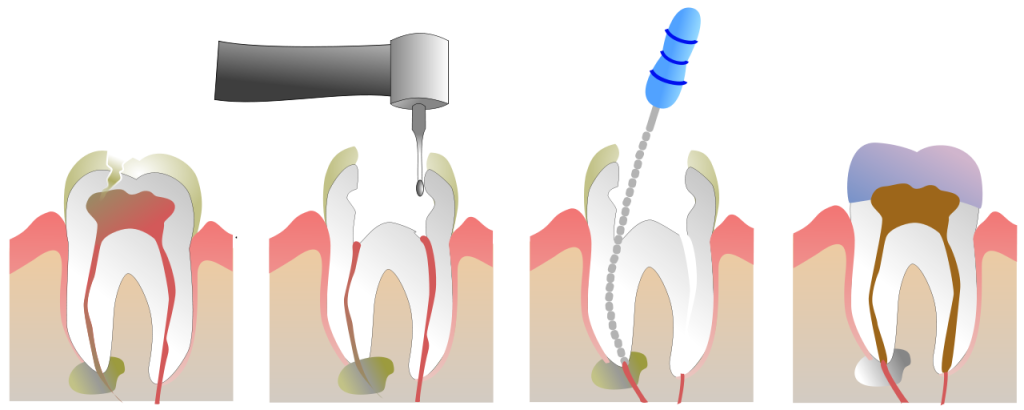 Tratamento de Canal - Dente Sim