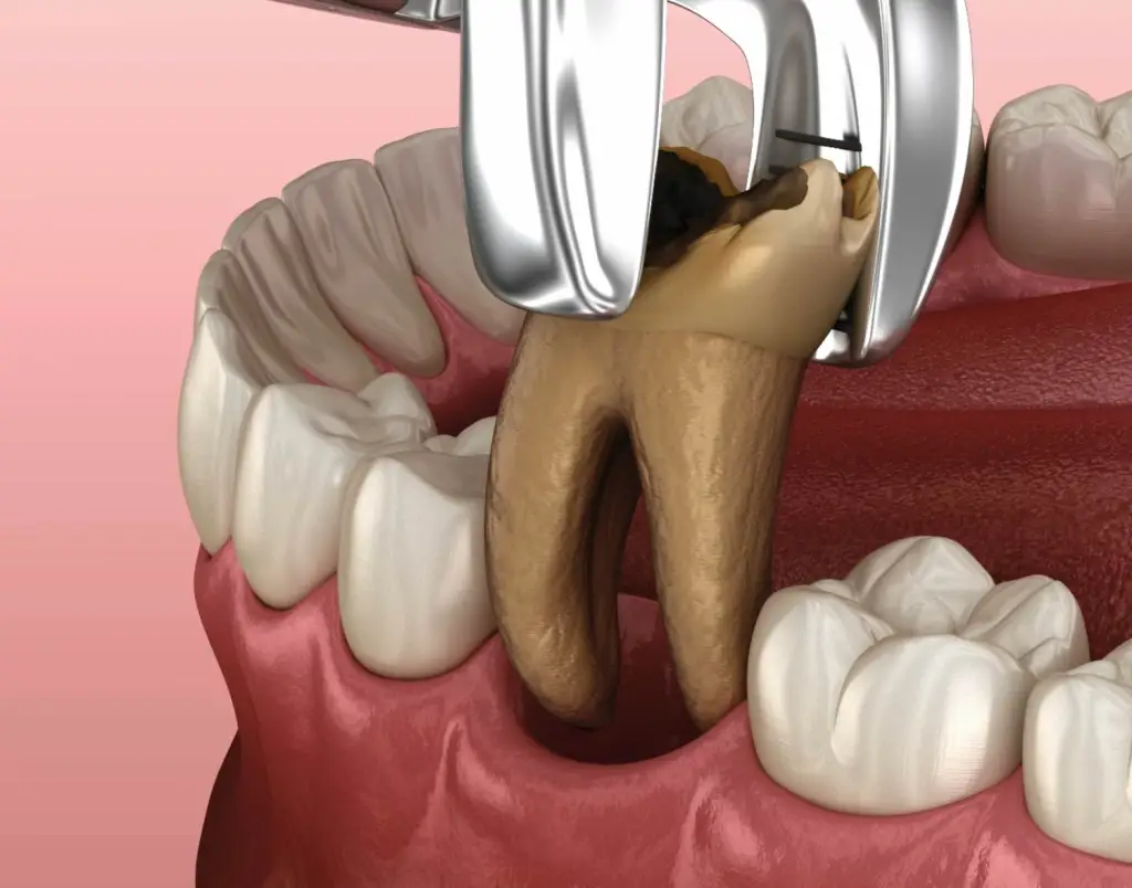 Procedimento de Extração Dentária - Dente Sim