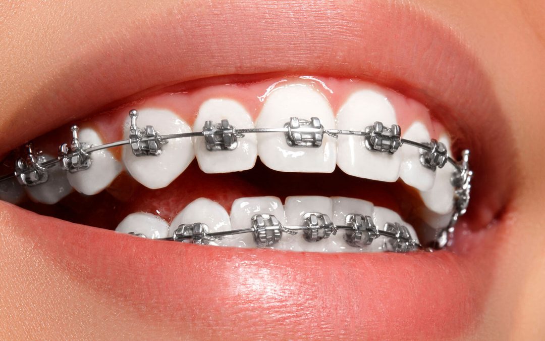 Ortodontia - Dente Sim