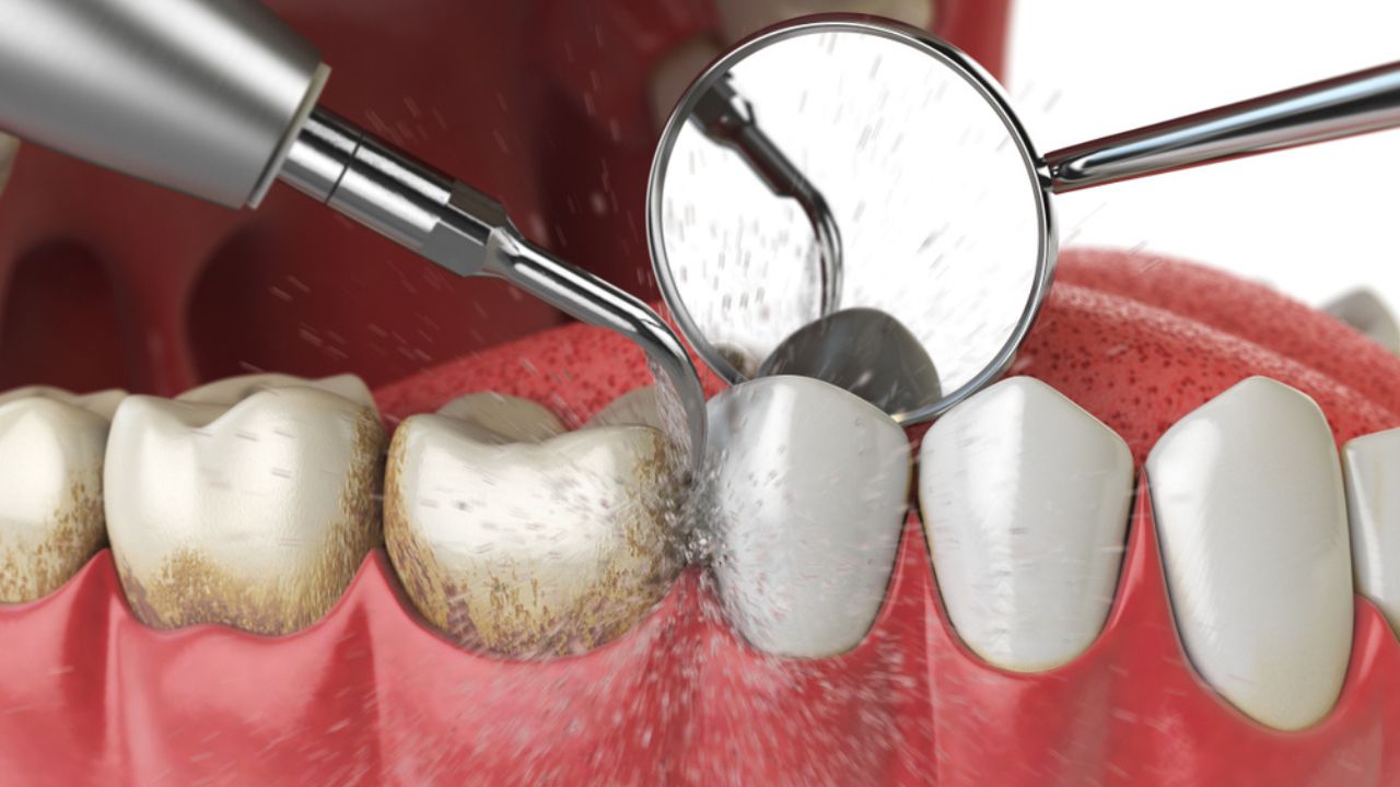 Profilaxia e Raspagem - Dente Sim